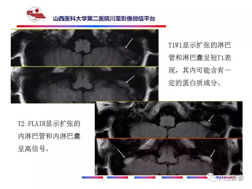 影像PPT - 【病例】上半规管裂综合征2例CT影像-31 影像PPT - 【病例】上半规管裂综合征2例CT影像-31
