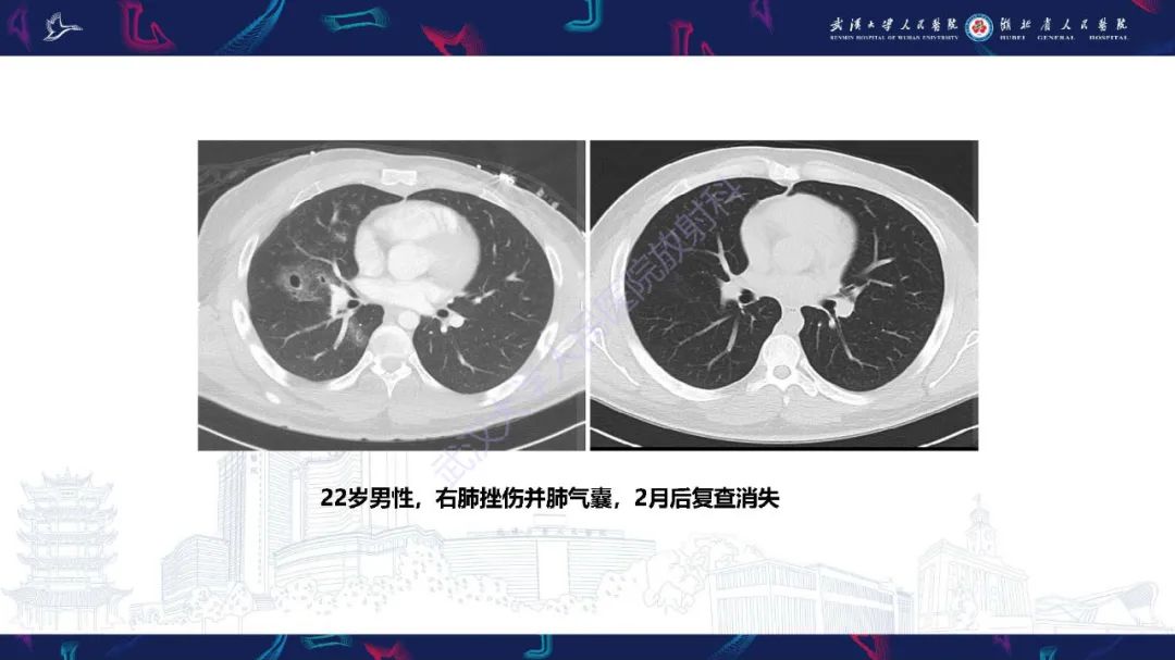 影像PPT - 【PPT】肺部囊性病变影像诊断-9