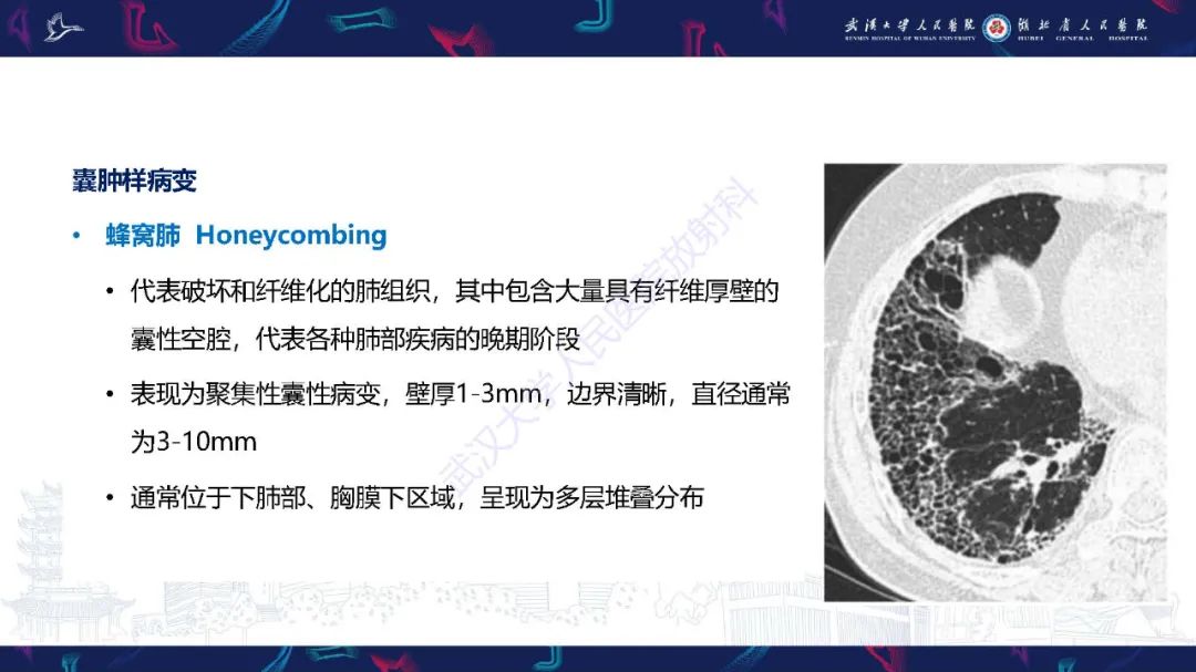 影像PPT - 【PPT】肺部囊性病变影像诊断-12