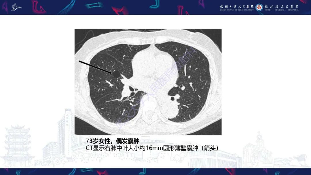 影像PPT - 【PPT】肺部囊性病变影像诊断-16