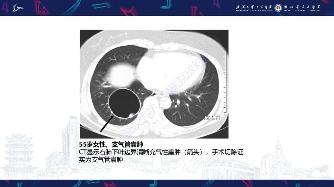 影像PPT - 【PPT】肺部囊性病变影像诊断-18