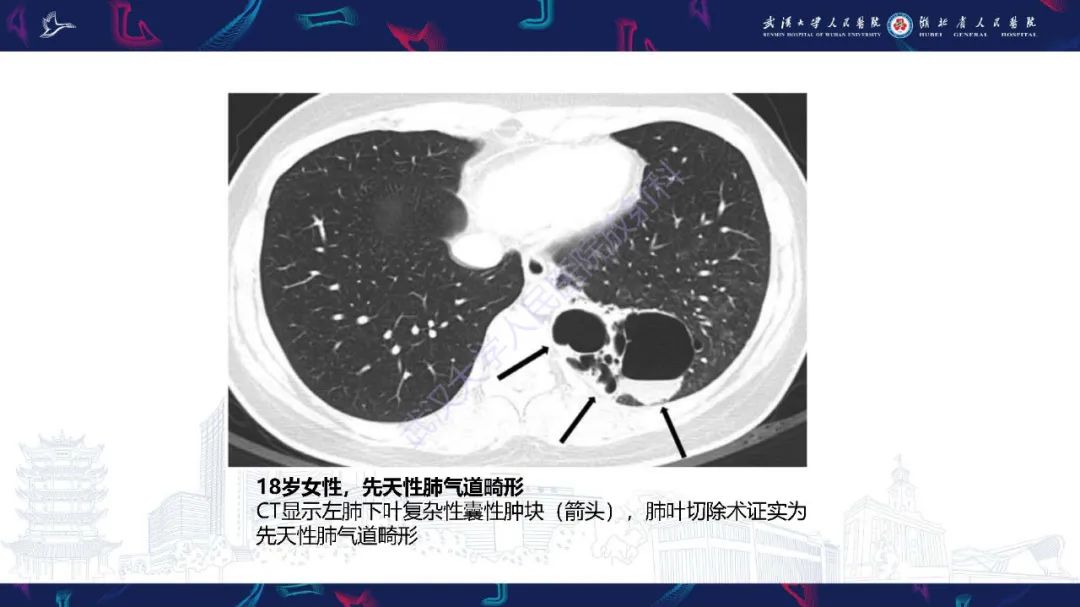 影像PPT - 【PPT】肺部囊性病变影像诊断-20