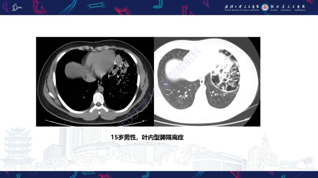 影像PPT - 【PPT】肺部囊性病变影像诊断-22