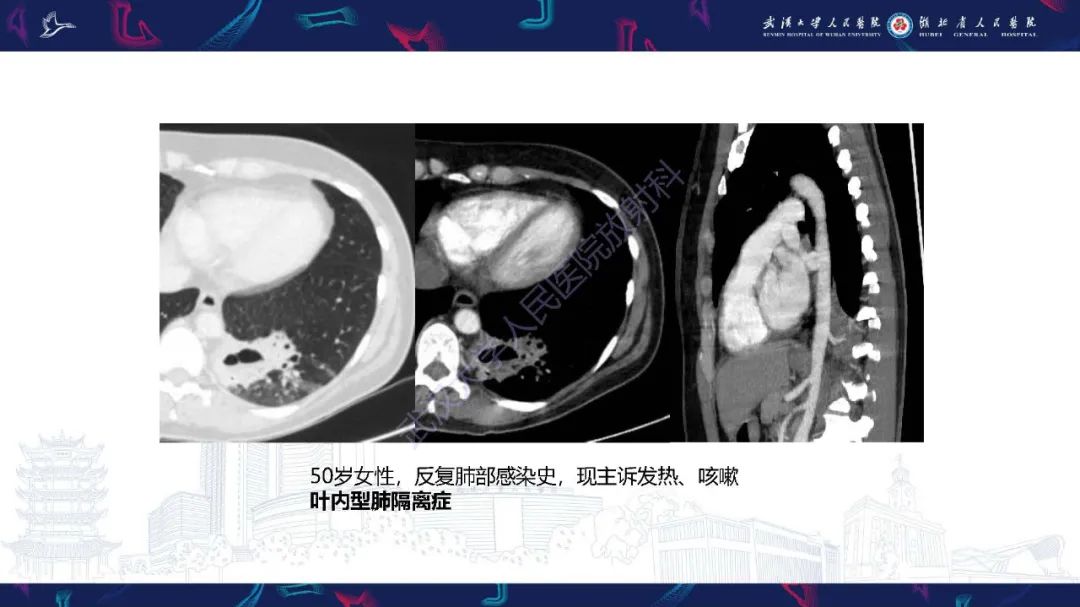 影像PPT - 【PPT】肺部囊性病变影像诊断-23
