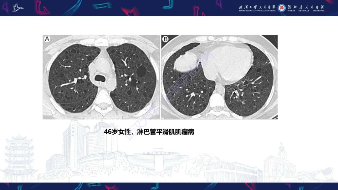 影像PPT - 【PPT】肺部囊性病变影像诊断-25
