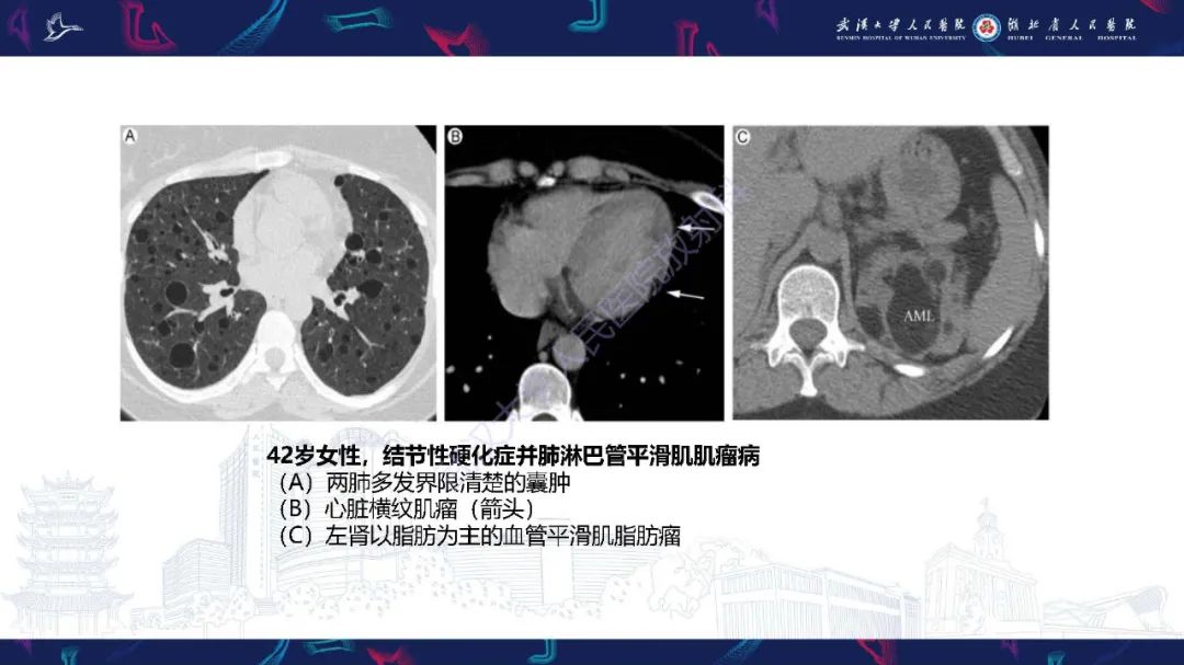 影像PPT - 【PPT】肺部囊性病变影像诊断-26