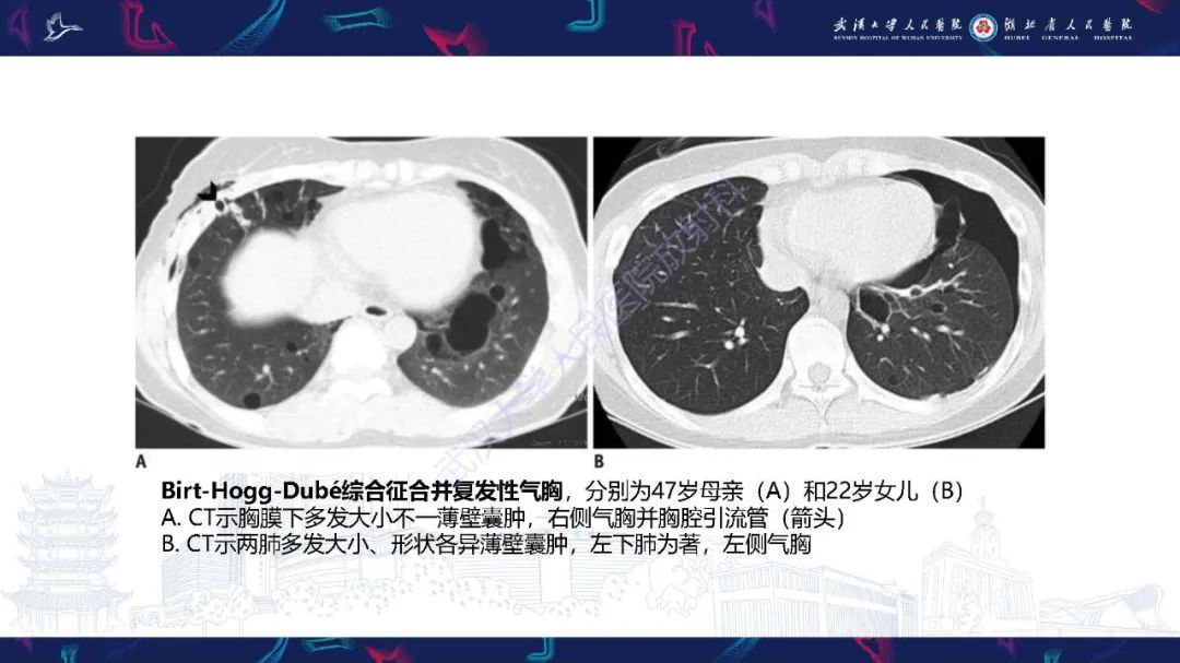 影像PPT - 【PPT】肺部囊性病变影像诊断-28