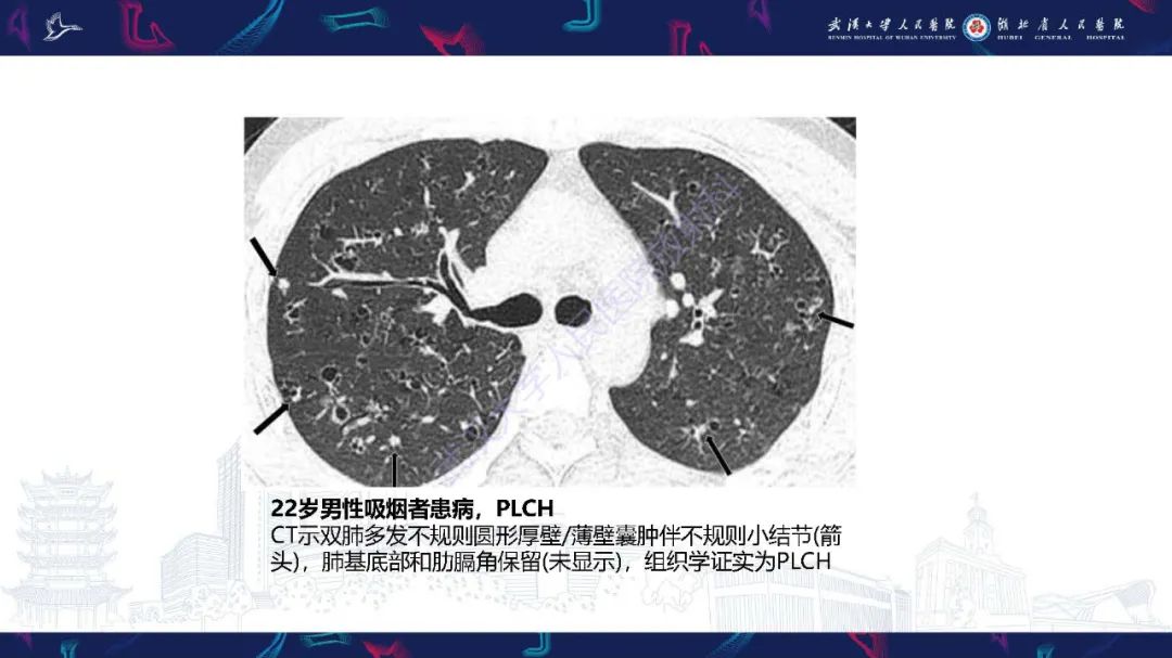 影像PPT - 【PPT】肺部囊性病变影像诊断-32