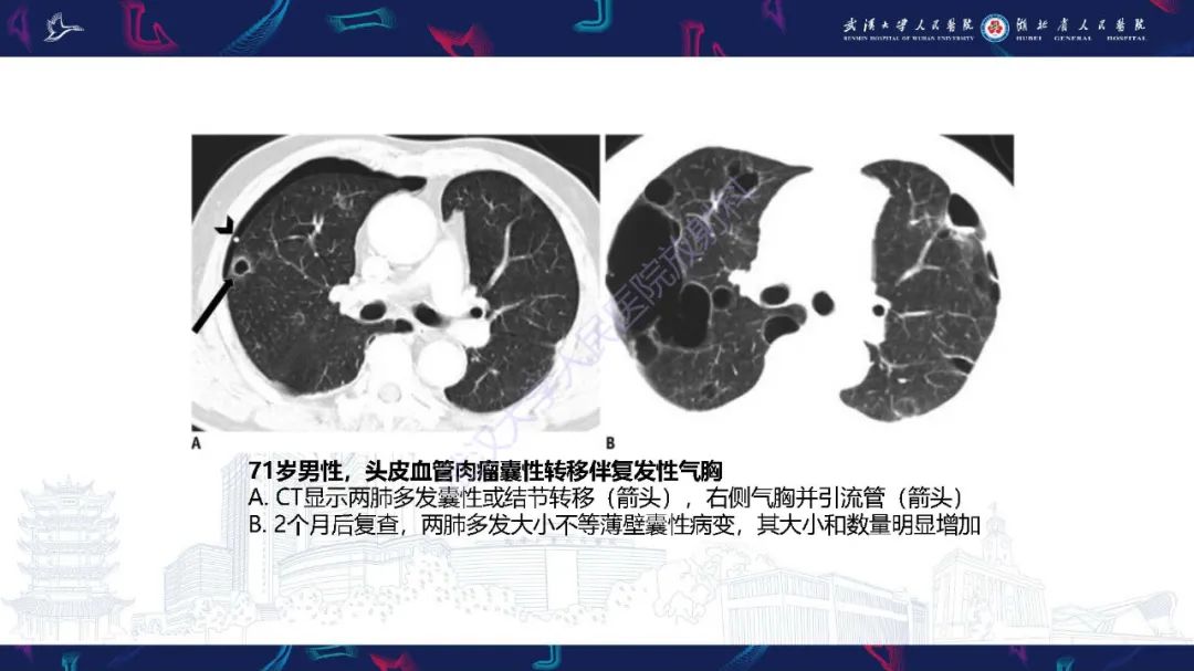 影像PPT - 【PPT】肺部囊性病变影像诊断-34