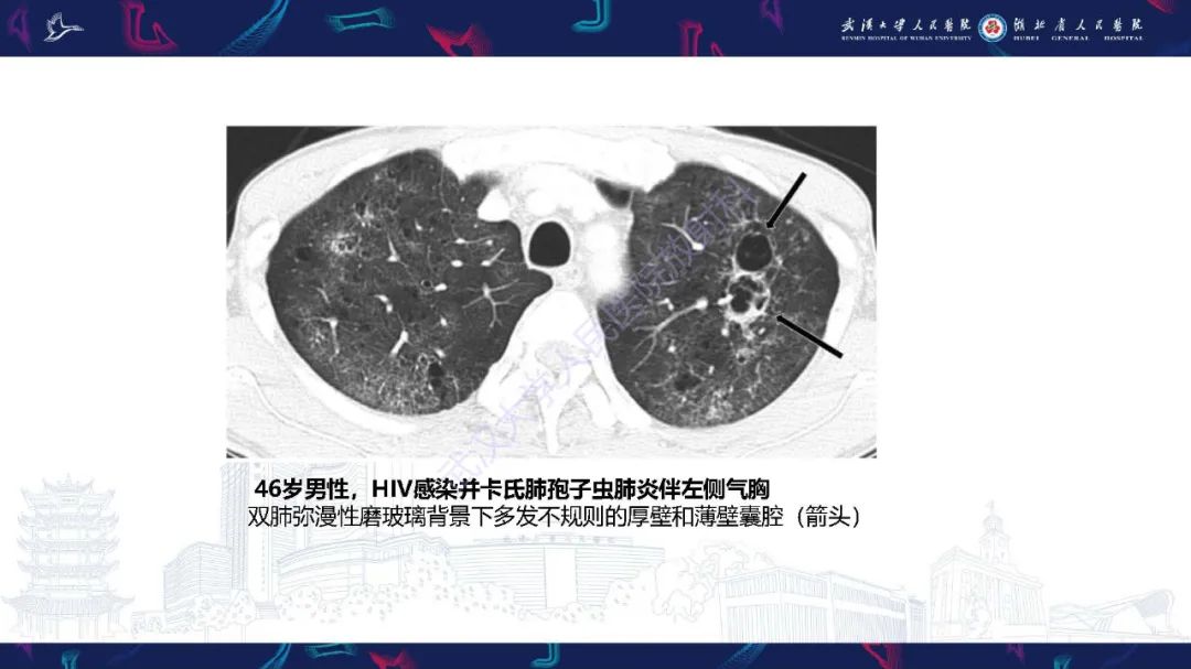 影像PPT - 【PPT】肺部囊性病变影像诊断-37