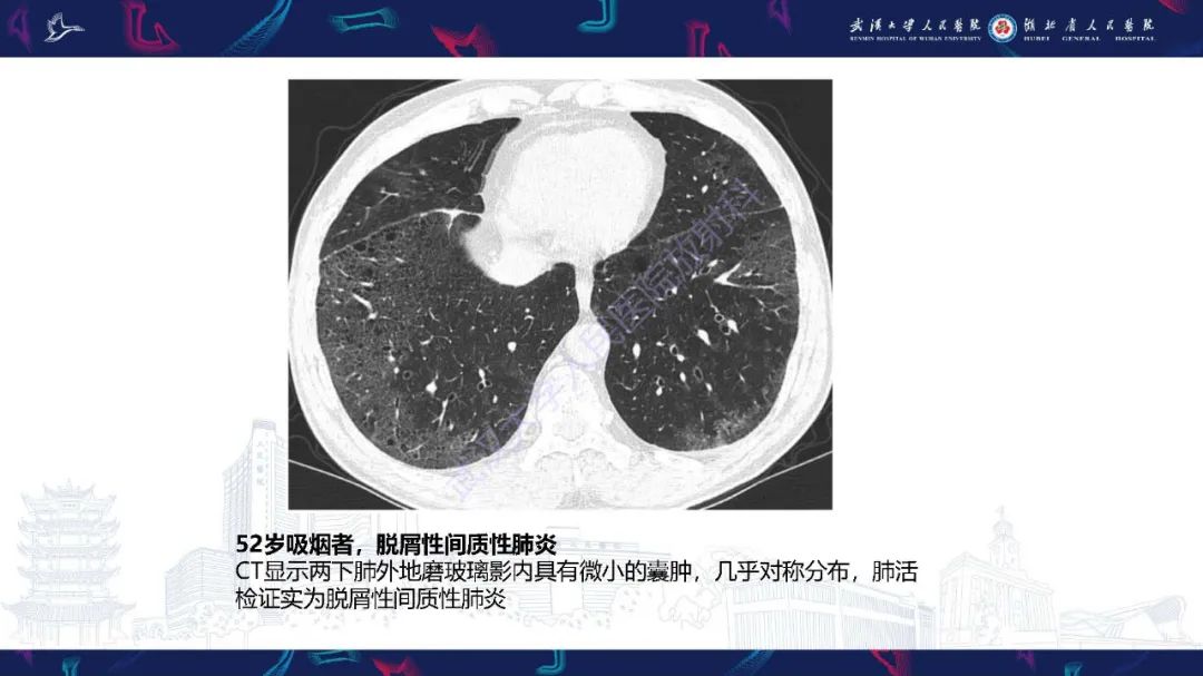 影像PPT - 【PPT】肺部囊性病变影像诊断-39