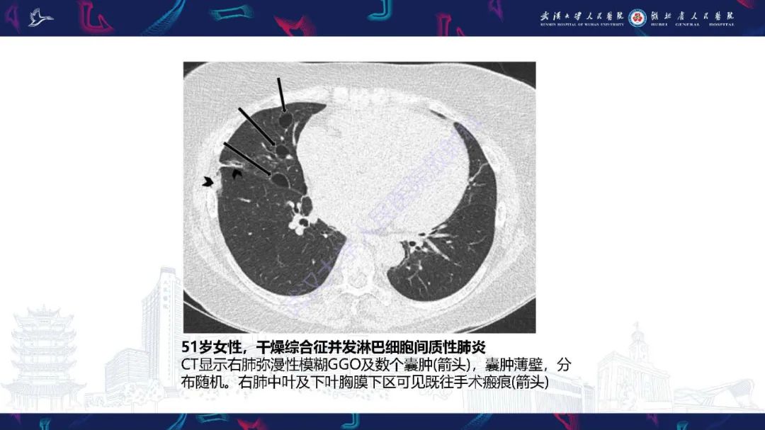 影像PPT - 【PPT】肺部囊性病变影像诊断-41