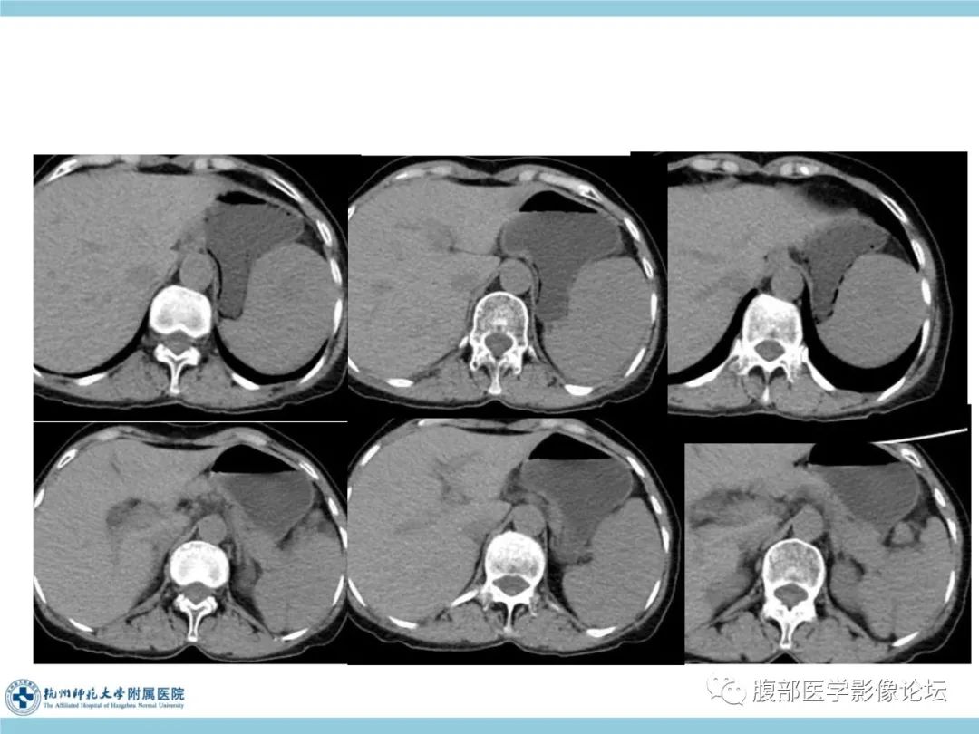 影像PPT - 【病例】脾脏淋巴瘤1例CT及MR影像讨论-5