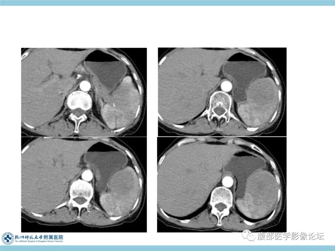 影像PPT - 【病例】脾脏淋巴瘤1例CT及MR影像讨论-7