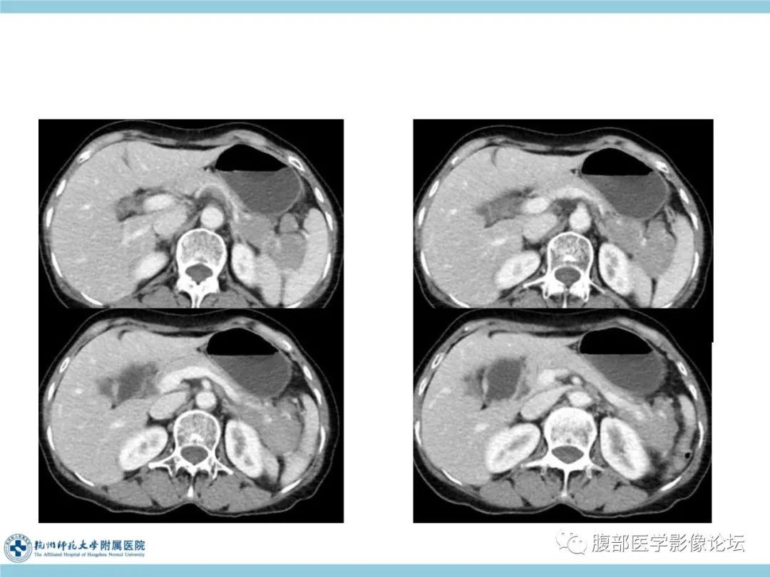 影像PPT - 【病例】脾脏淋巴瘤1例CT及MR影像讨论-8