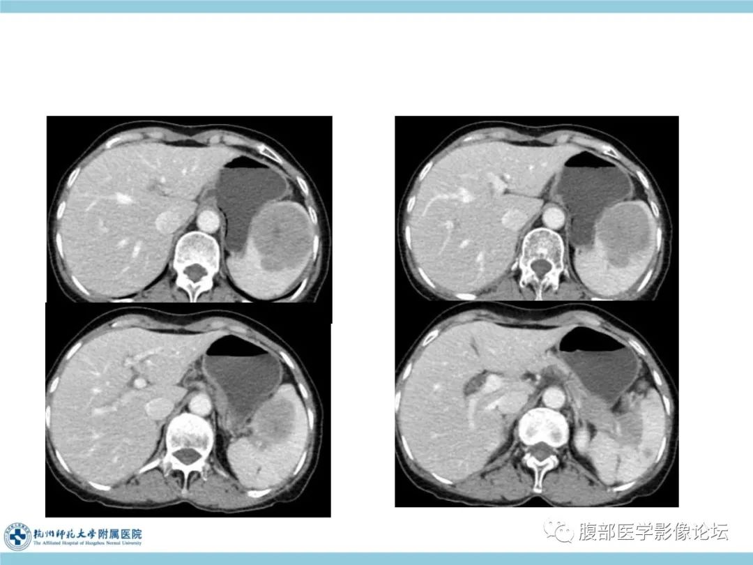 影像PPT - 【病例】脾脏淋巴瘤1例CT及MR影像讨论-9
