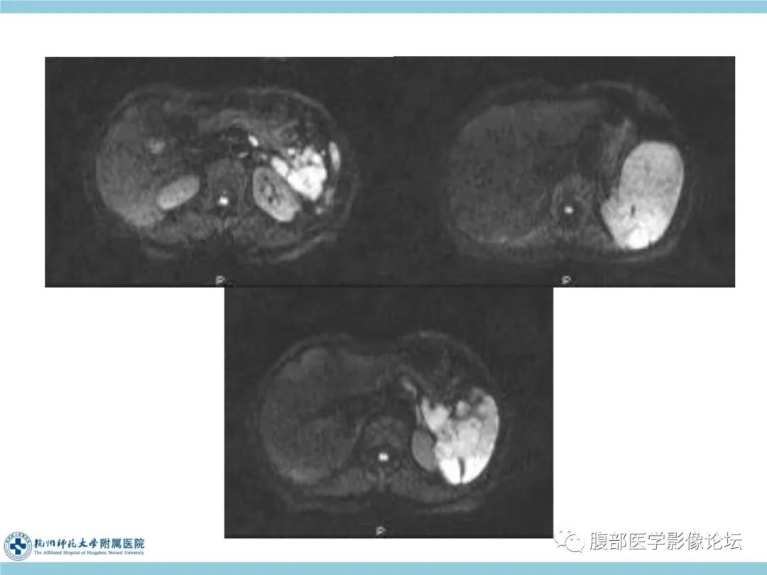 影像PPT - 【病例】脾脏淋巴瘤1例CT及MR影像讨论-11