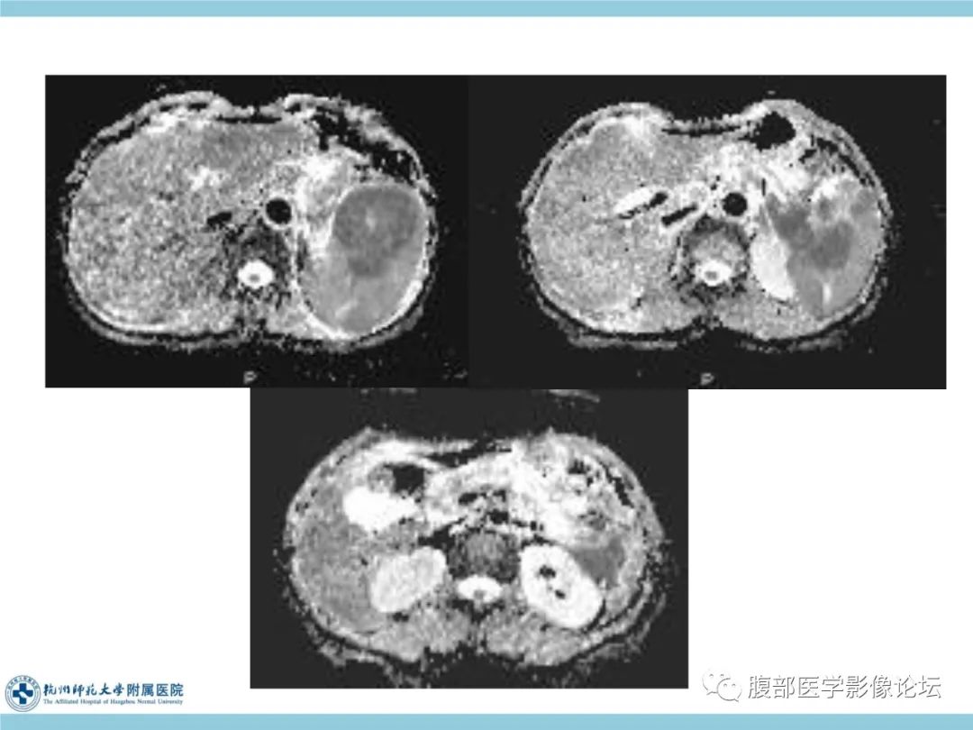 影像PPT - 【病例】脾脏淋巴瘤1例CT及MR影像讨论-12