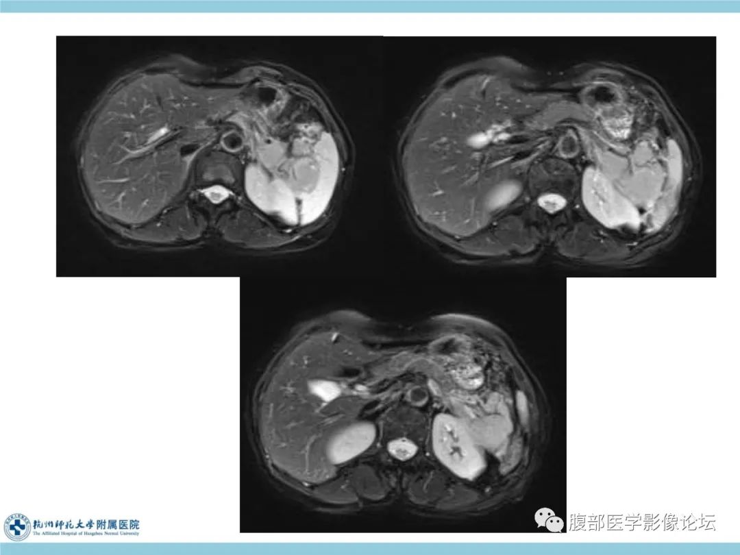 影像PPT - 【病例】脾脏淋巴瘤1例CT及MR影像讨论-13