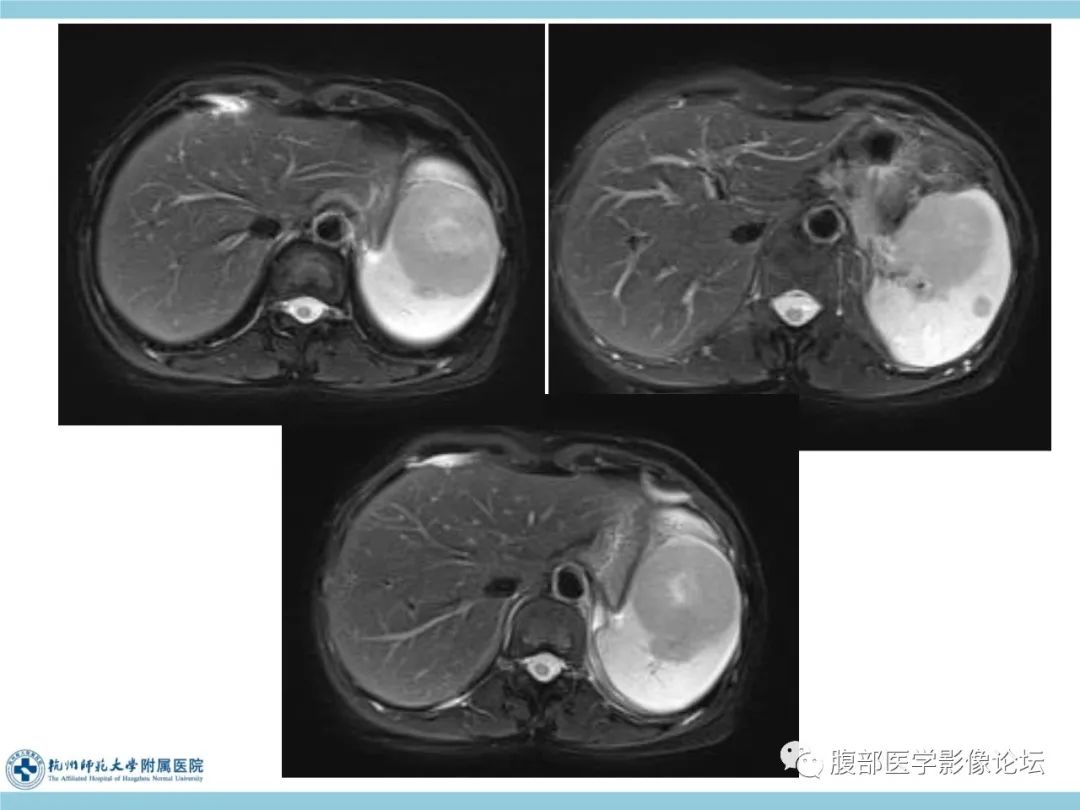 影像PPT - 【病例】脾脏淋巴瘤1例CT及MR影像讨论-14