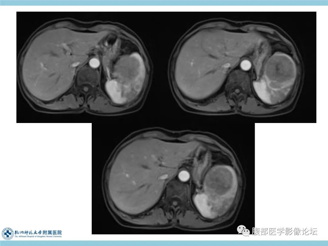 影像PPT - 【病例】脾脏淋巴瘤1例CT及MR影像讨论-15