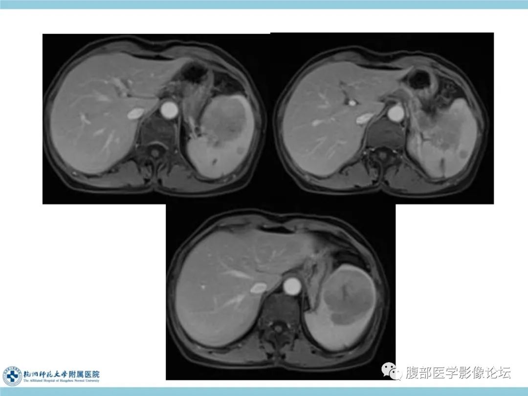 影像PPT - 【病例】脾脏淋巴瘤1例CT及MR影像讨论-17