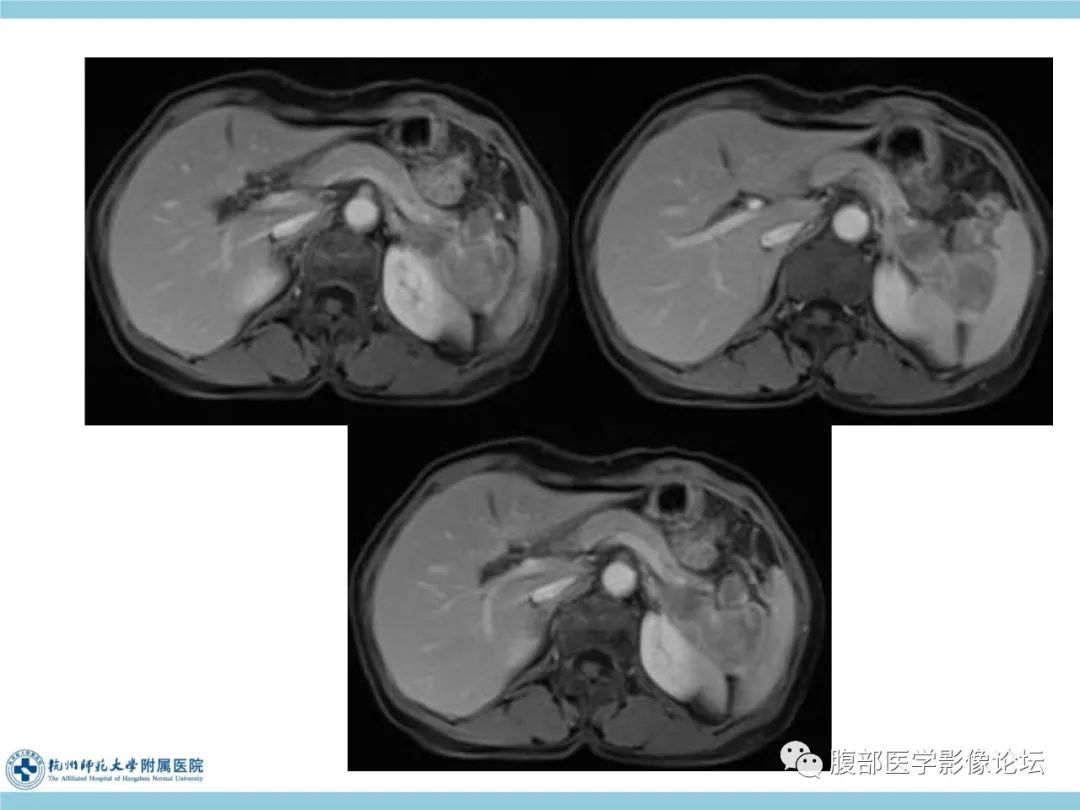 影像PPT - 【病例】脾脏淋巴瘤1例CT及MR影像讨论-18