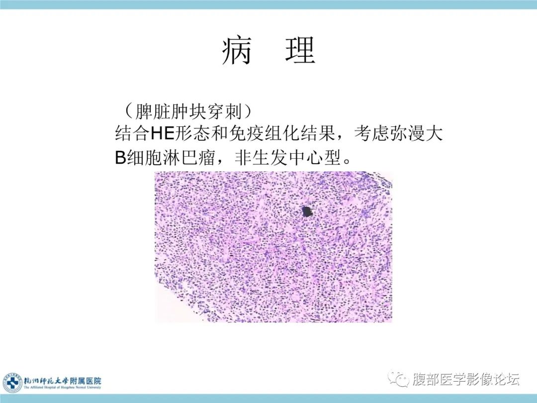 影像PPT - 【病例】脾脏淋巴瘤1例CT及MR影像讨论-26