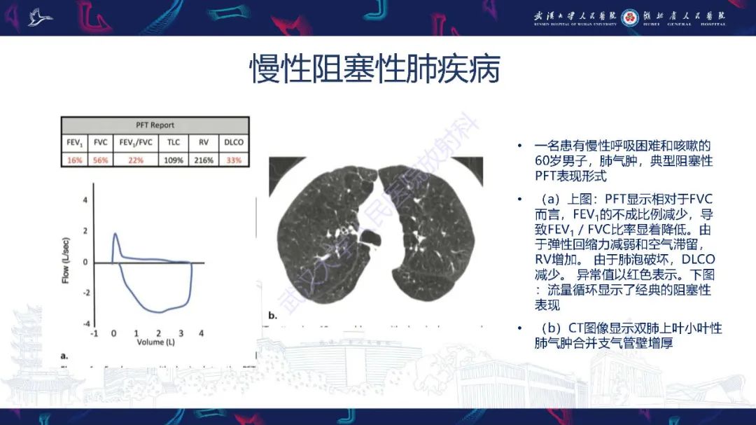 影像PPT - 【PPT】肺功能检查影像与临床-17