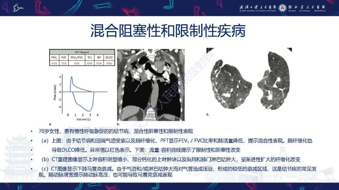 影像PPT - 【PPT】肺功能检查影像与临床-40