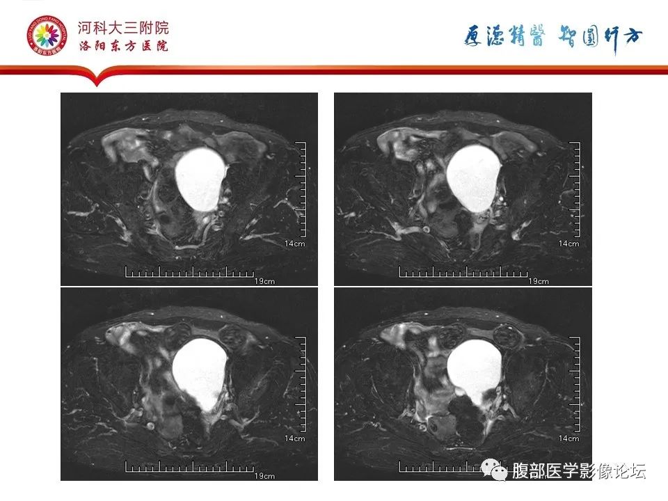 影像PPT - 【病例】卵巢Brenner瘤1例MR影像-3