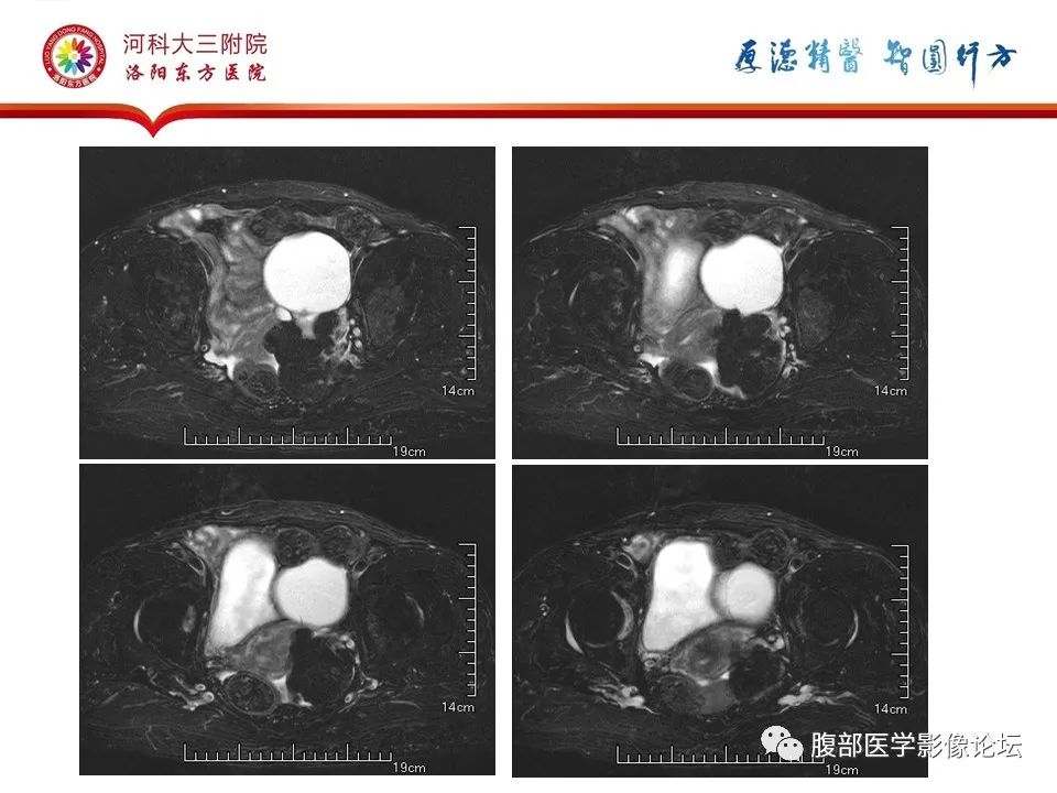 影像PPT - 【病例】卵巢Brenner瘤1例MR影像-4