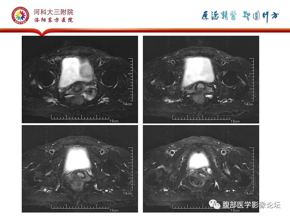 影像PPT - 【病例】卵巢Brenner瘤1例MR影像-5