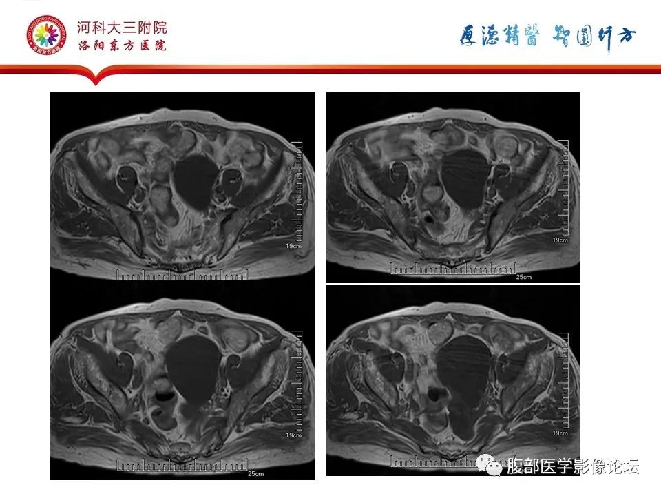 影像PPT - 【病例】卵巢Brenner瘤1例MR影像-6