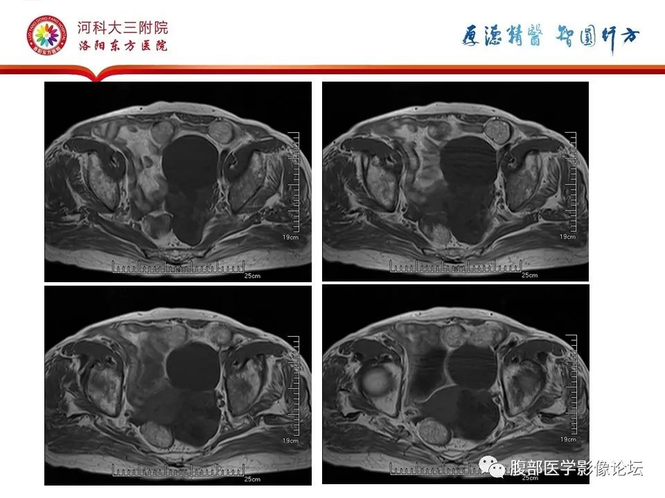 影像PPT - 【病例】卵巢Brenner瘤1例MR影像-7