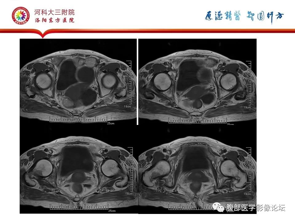 影像PPT - 【病例】卵巢Brenner瘤1例MR影像-8