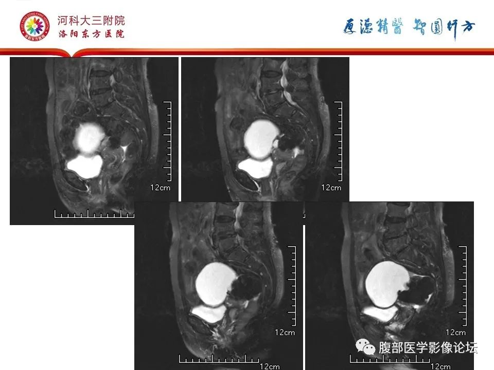 影像PPT - 【病例】卵巢Brenner瘤1例MR影像-9