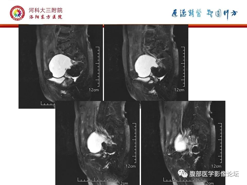 影像PPT - 【病例】卵巢Brenner瘤1例MR影像-10