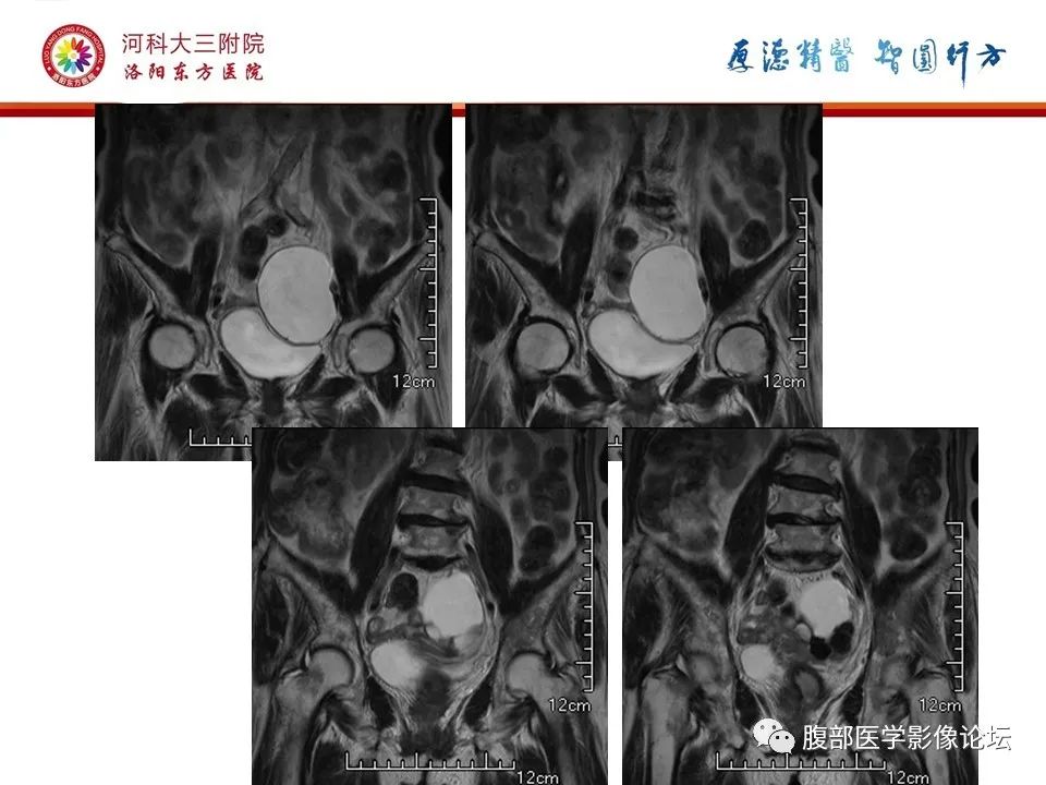 影像PPT - 【病例】卵巢Brenner瘤1例MR影像-11