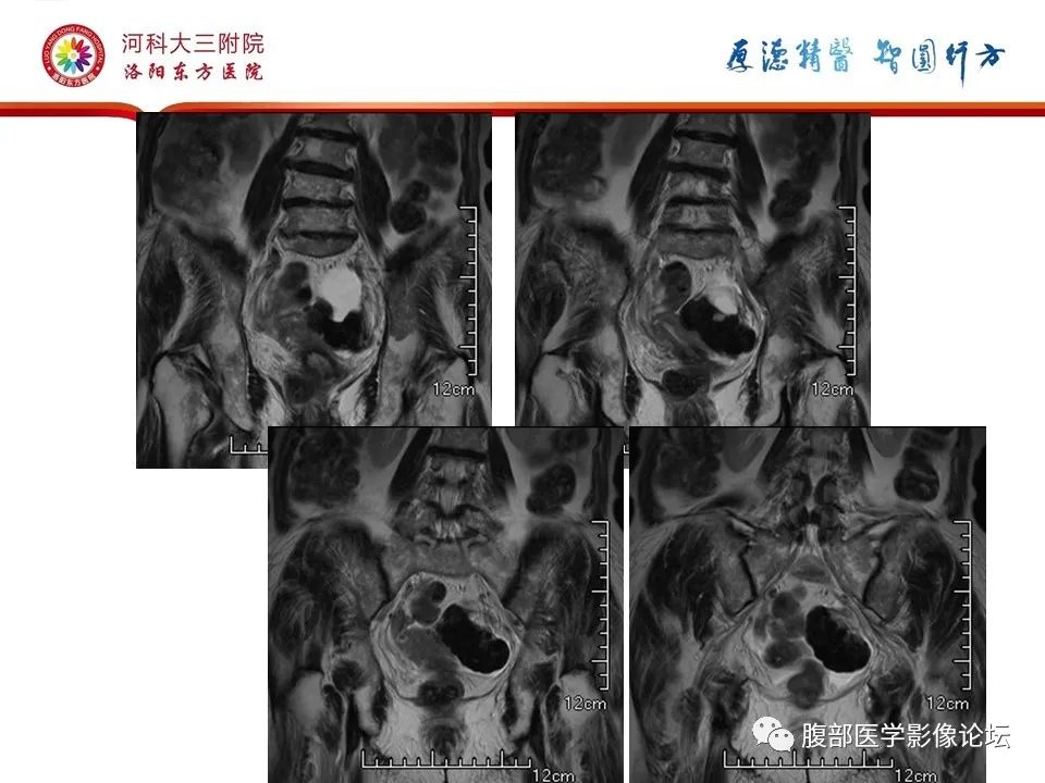 影像PPT - 【病例】卵巢Brenner瘤1例MR影像-12