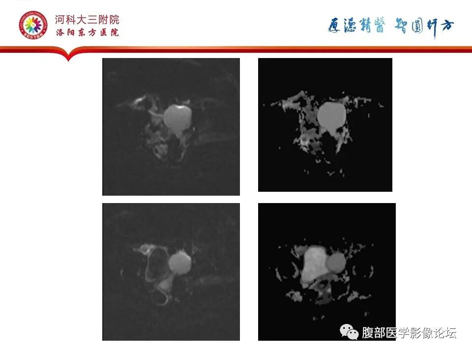 影像PPT - 【病例】卵巢Brenner瘤1例MR影像-13