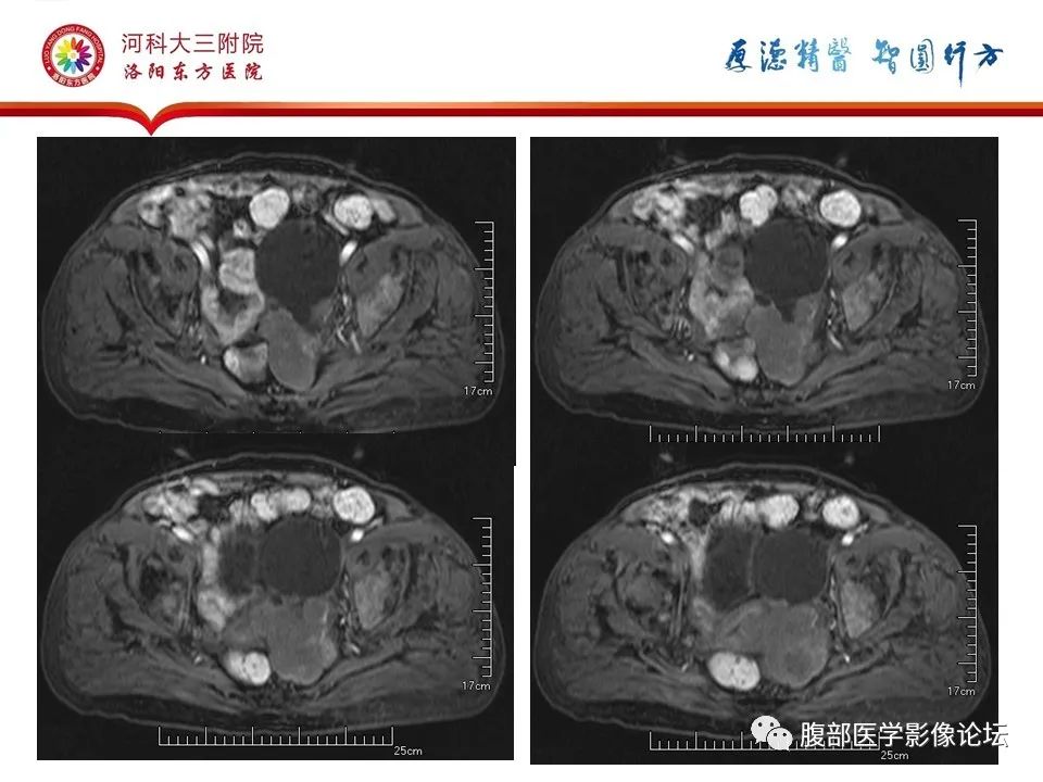 影像PPT - 【病例】卵巢Brenner瘤1例MR影像-14