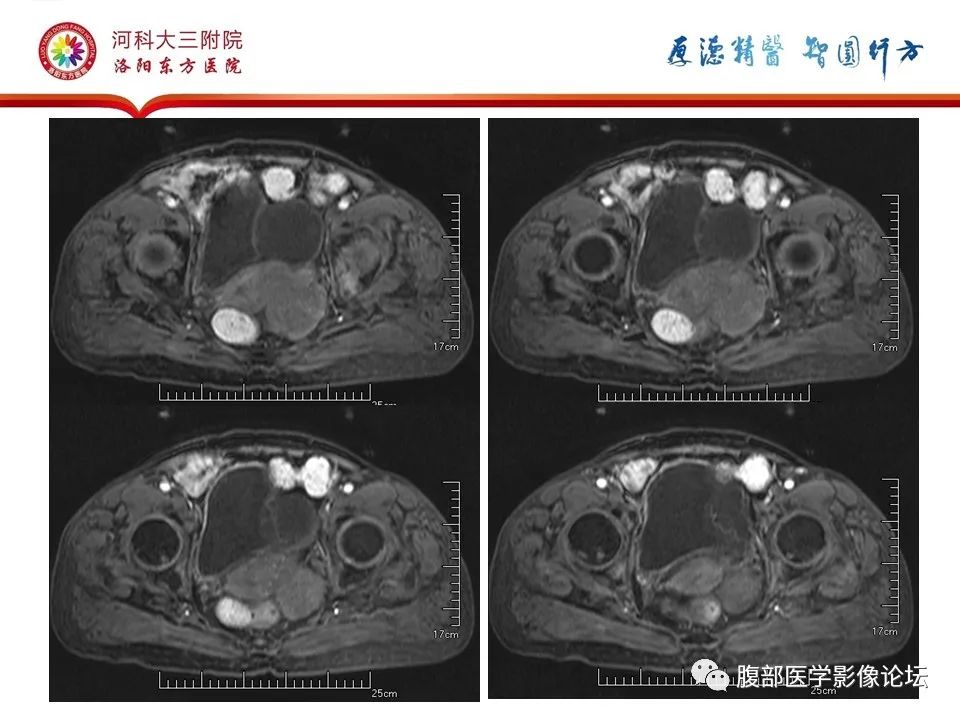 影像PPT - 【病例】卵巢Brenner瘤1例MR影像-15
