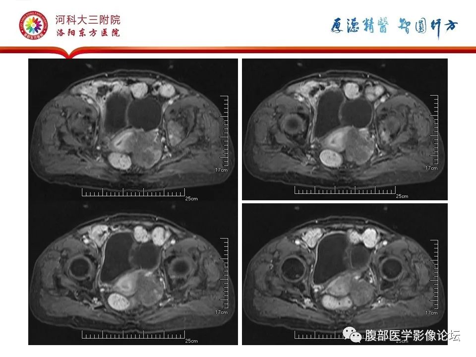 影像PPT - 【病例】卵巢Brenner瘤1例MR影像-16
