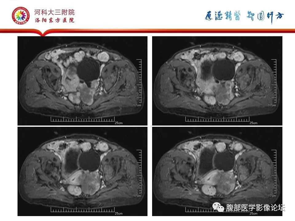 影像PPT - 【病例】卵巢Brenner瘤1例MR影像-17