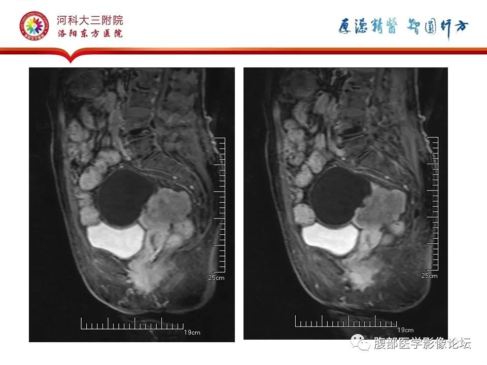 影像PPT - 【病例】卵巢Brenner瘤1例MR影像-18