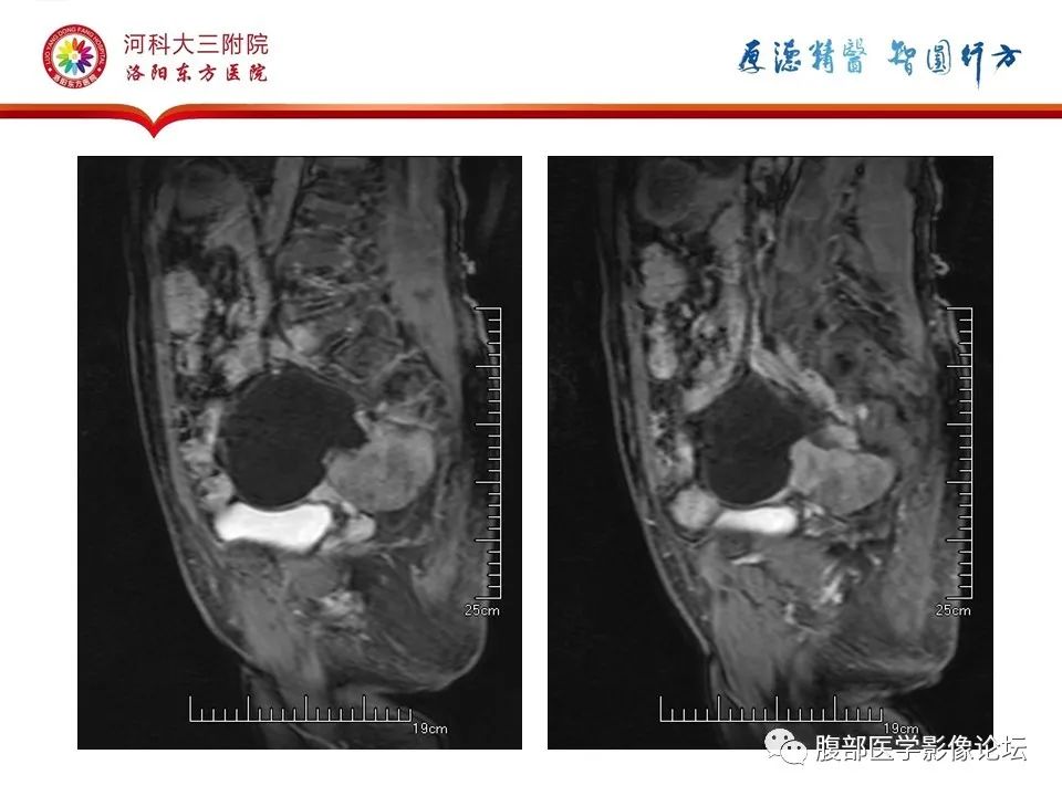 影像PPT - 【病例】卵巢Brenner瘤1例MR影像-19