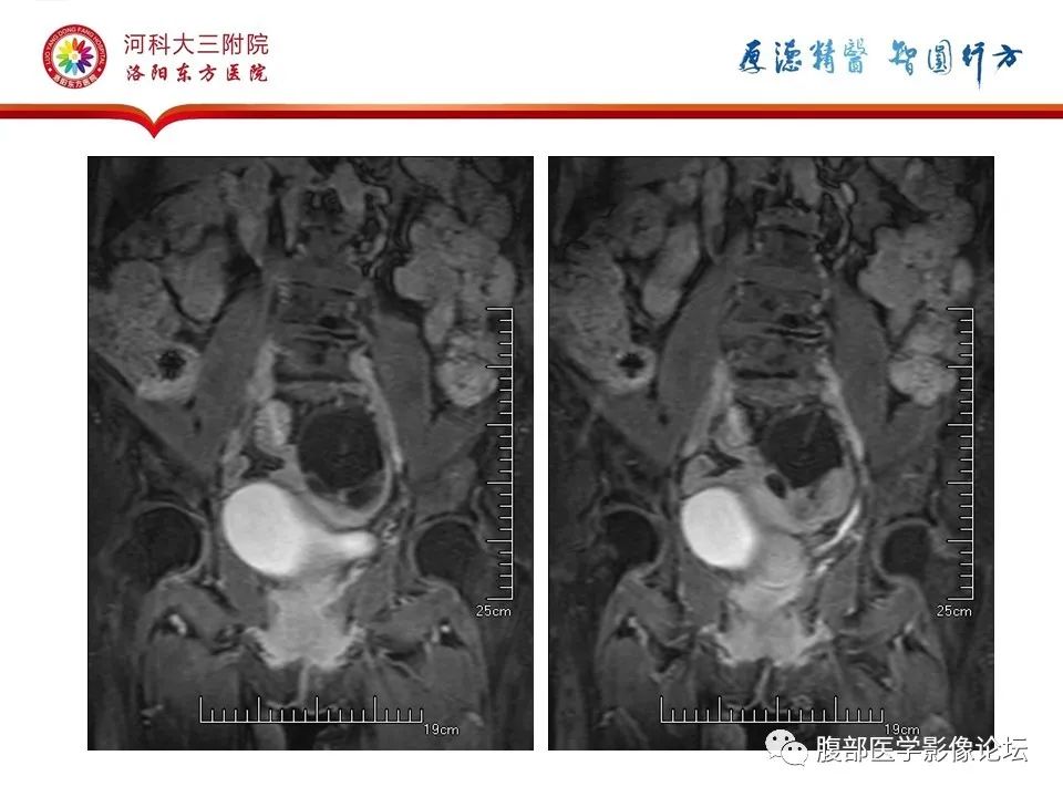 影像PPT - 【病例】卵巢Brenner瘤1例MR影像-20