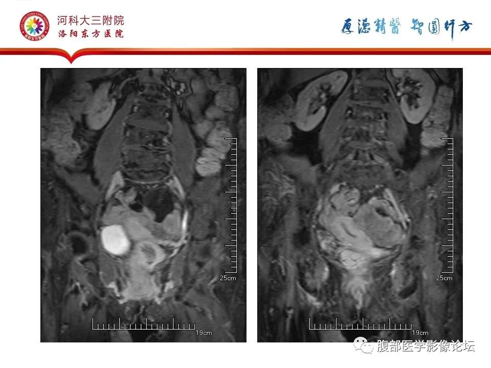 影像PPT - 【病例】卵巢Brenner瘤1例MR影像-21