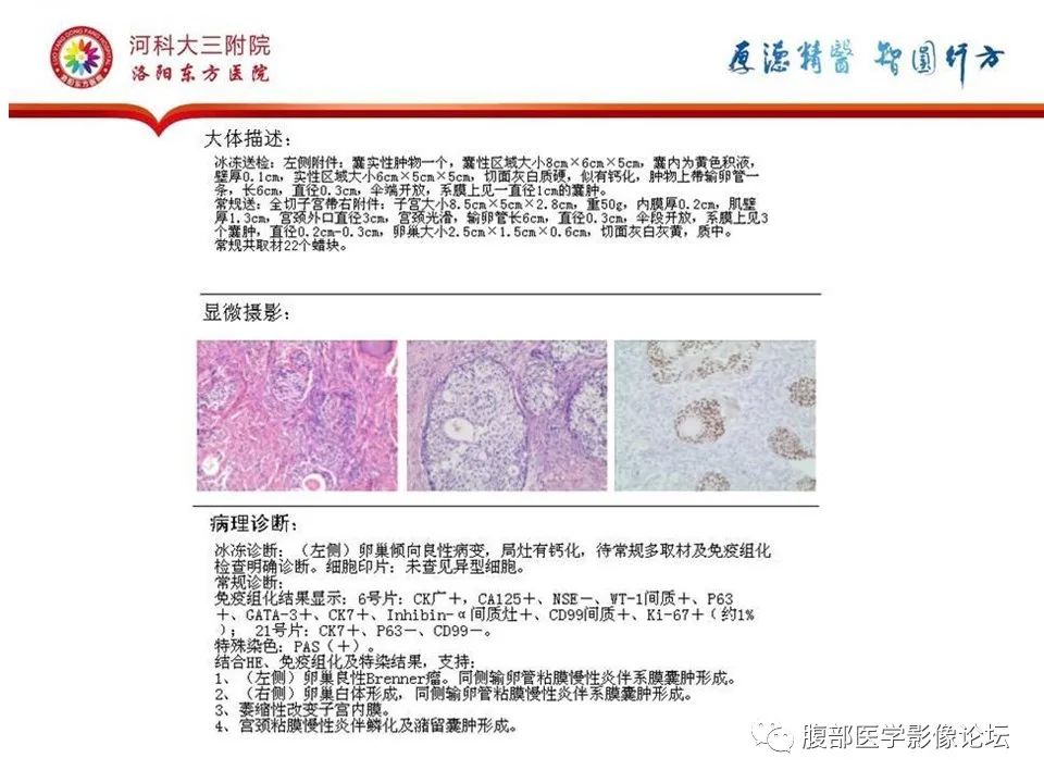 影像PPT - 【病例】卵巢Brenner瘤1例MR影像-22